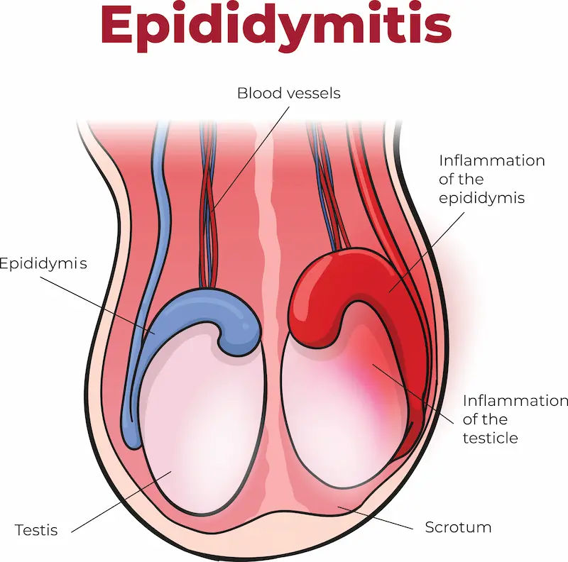 Epididymitis Overview Symptoms, Causes, and Treatment